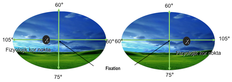 Tilted Disk Sendromu